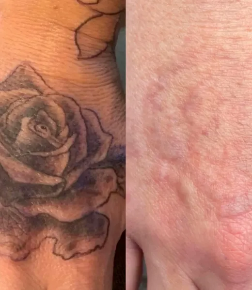 tattoo_removal_before_after_2000